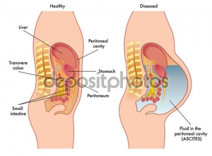 Một Số Bệnh Lý Về Gan Kho Có Dấu Hiệu Bị Chướng Bụng
